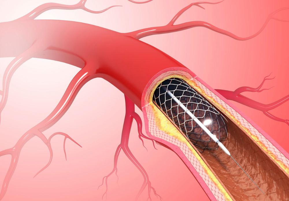 Exames Cardiologicos Intervencionistas - Hemodinamica - Angioplastia