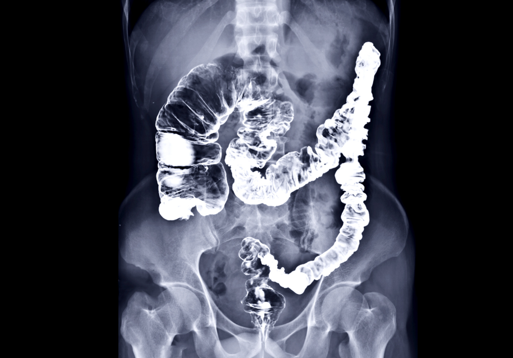 Exames Radiologicos - Enema Opaco